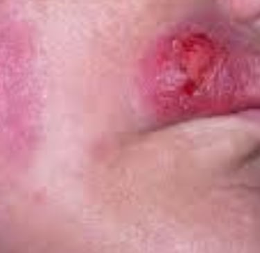 Multiple Body Abscesses Fasting and Honey