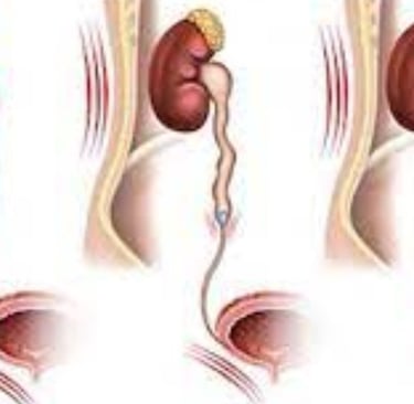 ureteric stone