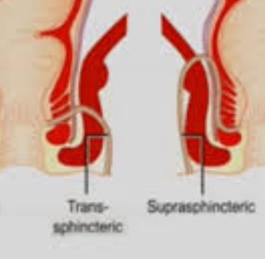 The use of honey in the management of anal fistulas may reduce pain and facilitate healing