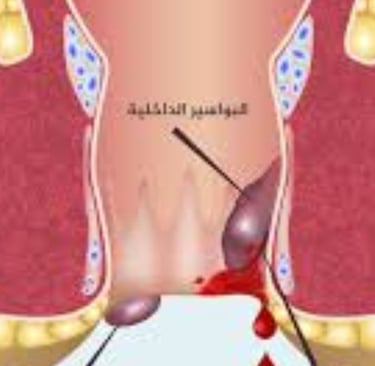 البواسير هي مصدر شائع للدم الأحمر الفاتح في البراز