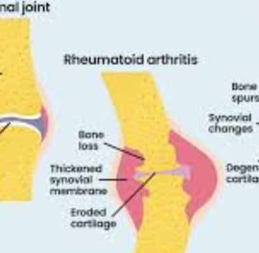 Early Stages of Rheumatoid Arthritis (RA)