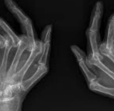 Stages of Rheumatoid Arthritis