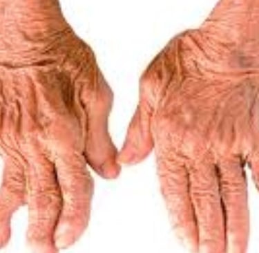 التهاب المفاصل الروماتويدي نهج متعدد في العلاج - الصيام