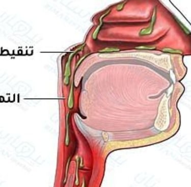 تنقيط والتهاب