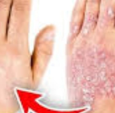 الصيام لعلاج حساسية الجلد الحكة والهرش