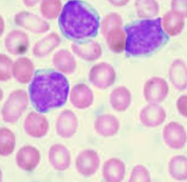 والعلاج والشفاء leukemia لبوكيميا