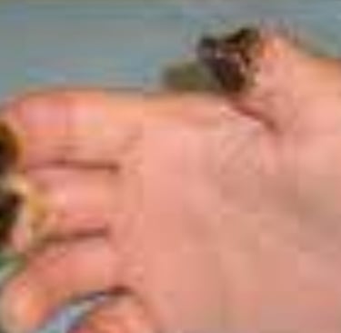 Painful Digital Ulcers : role of Role of Fasting and Cold Water