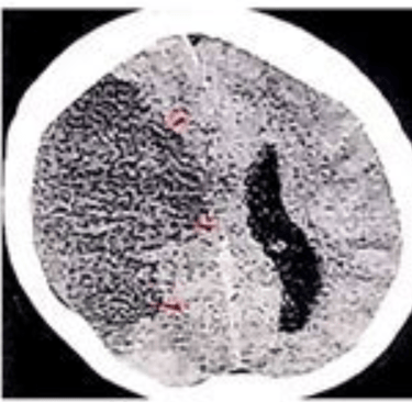 stroke ct