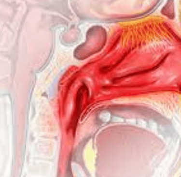 Posterior Nasal Bleeding Is a type of nosebleed that occurs at the back of the nasal cavity