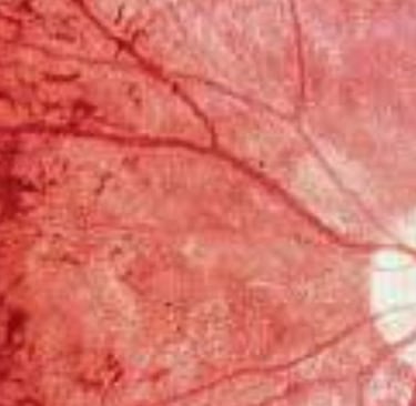 retinitis pigmentosa