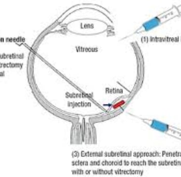 Retinitis Pigmentosa Fasting, Autophagy, Stem Cells, and Emerging Therapies