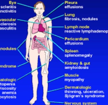 rheumatoid arthritis extra-articular manifestations