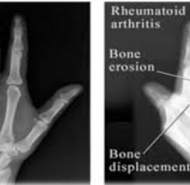 Rheumatoid Arthritis