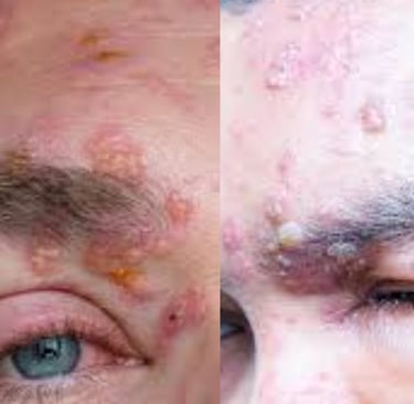 Shingles (Herpes Zoster) “Belt of Fire” Traditional vs. Strange Treatments 