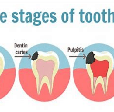tooth caries 