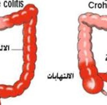 مرض كرون