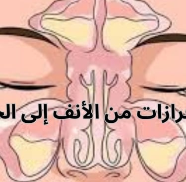 علاج إفرازات الأنف الخلفية الناجمة عن التهابات الجيوب