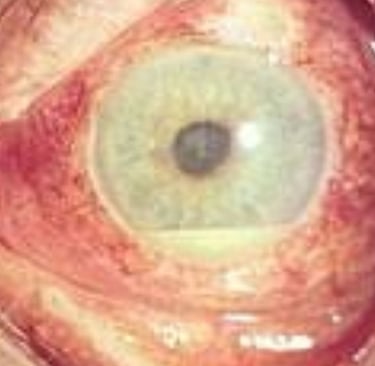 ماذا تعرف عن اسباب وتشخيص وعلاجات مرض بهجت