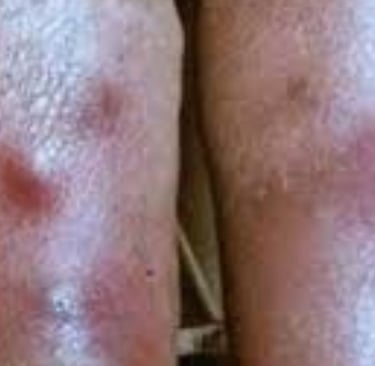 طفح جلدي أو ندوب حمراء، وقد تترافق مع حكة أو ألم