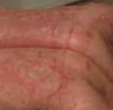 طفح جلدي أو ندوب حمراء، وقد تترافق مع حكة أو ألم