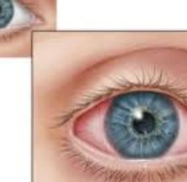 التهاب القزحية أو الشبكية