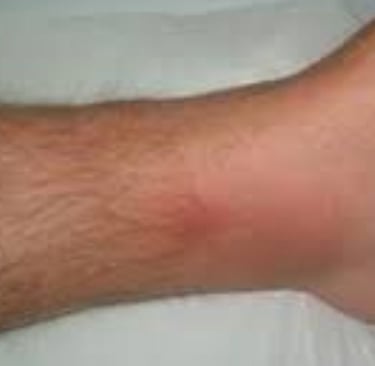 احمرار الساق