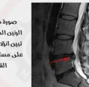 herniated disc,disc herniation,bulging disc,herniated disc surgery