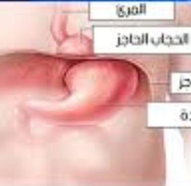 هو وحر الصدر فتق الحجاب الحاجز