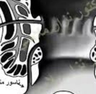 الشرخ و الناسور الشرجي