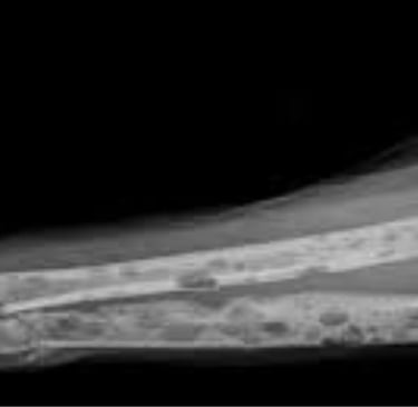 a broken bone bone bone fracture