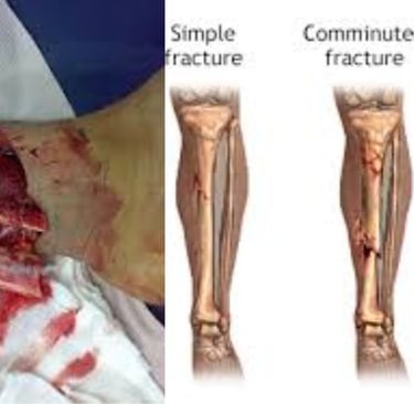 compound fracture