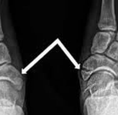 fracure foot