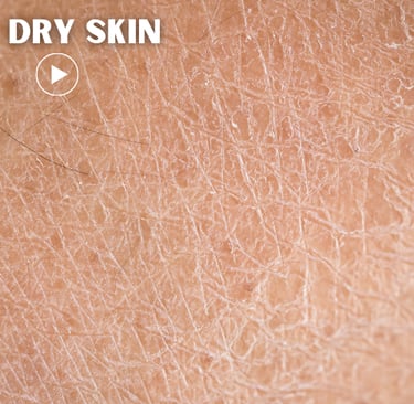 dry skin
