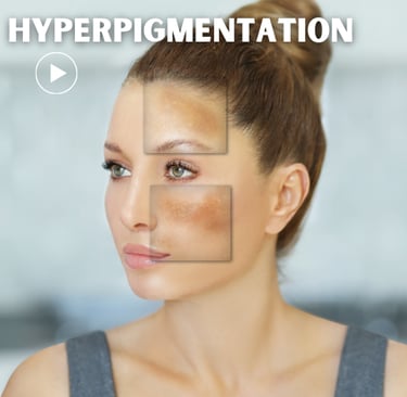 a woman face with hyperpigmentation