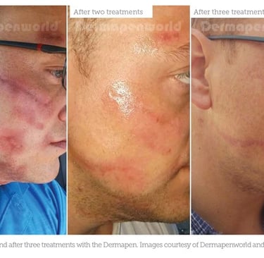 a man before and after dermapen 4