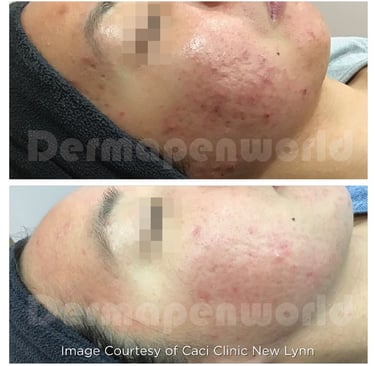 a person before and after dermapen 4 acne