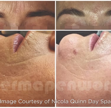 a person before and after dermapen 4