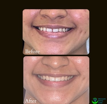 Teeth straightening with invisible braces like invisalign aligners by top orthodontist in Malad