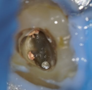 Missed root canal treatment visible under microscope by Dr. Paras Kothari