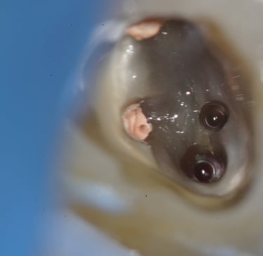 Cleaning of missed root canal under dental microscope