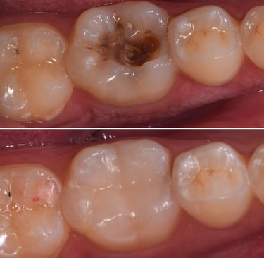 Deep teeth cavity treated with tooth colored filling of bonded composite resin by best dentist in malad west