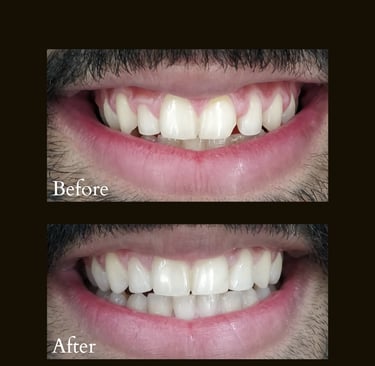 Bleeding gums treatment and Ceramic Veneers by Gums Specialist near Goregaon Mumbai