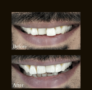 Crooked teeth treatment with ceramic tooth colored cap by Top cosmetic dentist near Orlem Malad west Mumbai