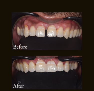 Teeth gap closure with Invisalign invisible braces and aligners done by best cosmetic dentist near Malad West in Mumbai