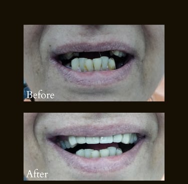 Ceramic Caps with dental implants used for replacing missing front teeth giving beautiful smile