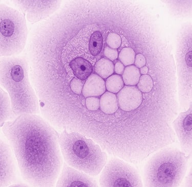 Histologia câncer de colo