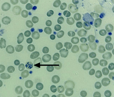 lâmina de hemograma corada para contar reticulócitos