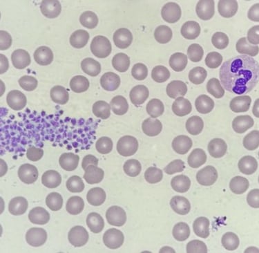 lâmina de hemograma com um coágulo de plaquetas, hemáceas e um neutrófilo