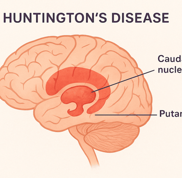 Huntington's disease 