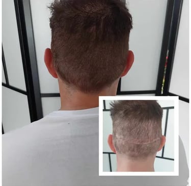 Micropigmentation, camouflage de cicatrice. Tricopigmentation, pigmentation capillaire